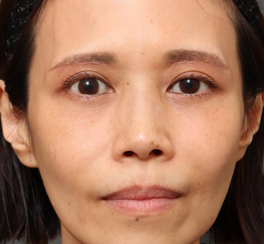 40代女性の眉下切開法 After 症例写真