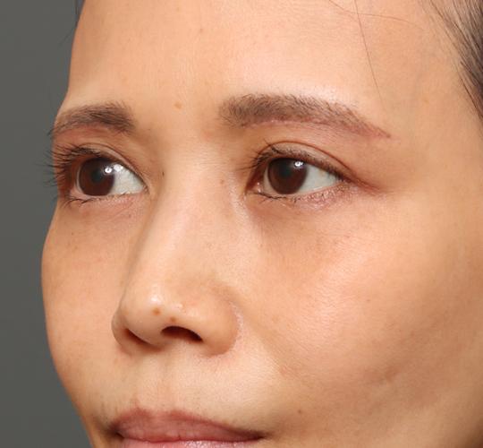 40代女性の眉下切開法 After 症例写真