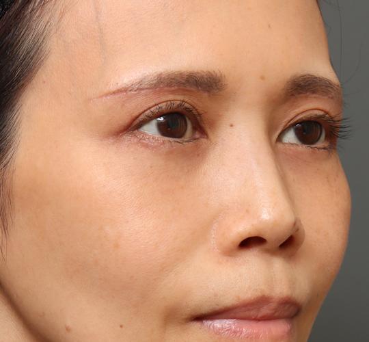 40代女性の眉下切開法 After 症例写真