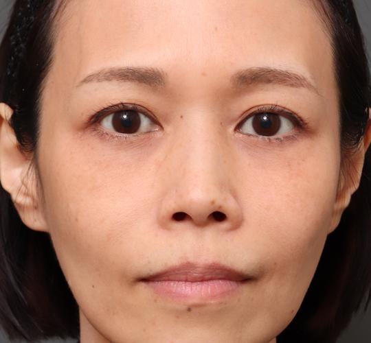 40代女性の眉下切開法 Before 症例写真