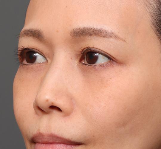 40代女性の眉下切開法 Before 症例写真