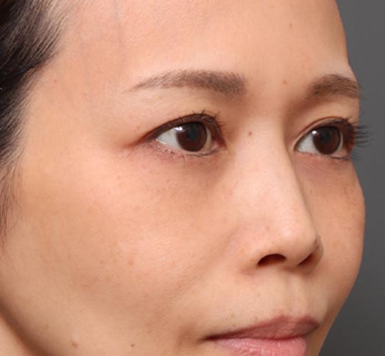 40代女性の眉下切開法 Before 症例写真