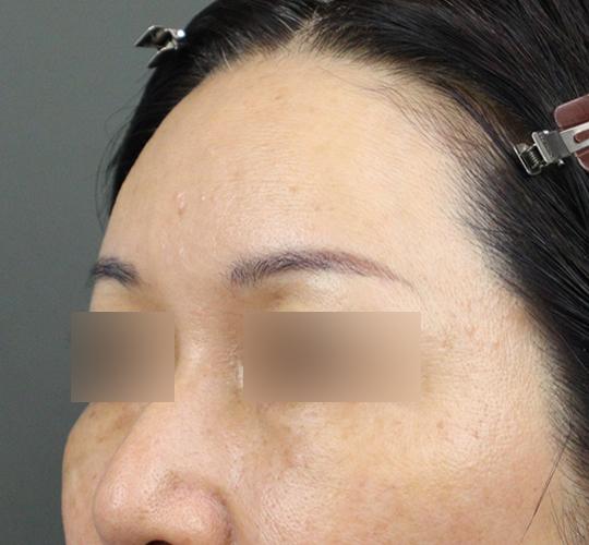 50代女性のヒアルロン酸注射（額） After 症例写真