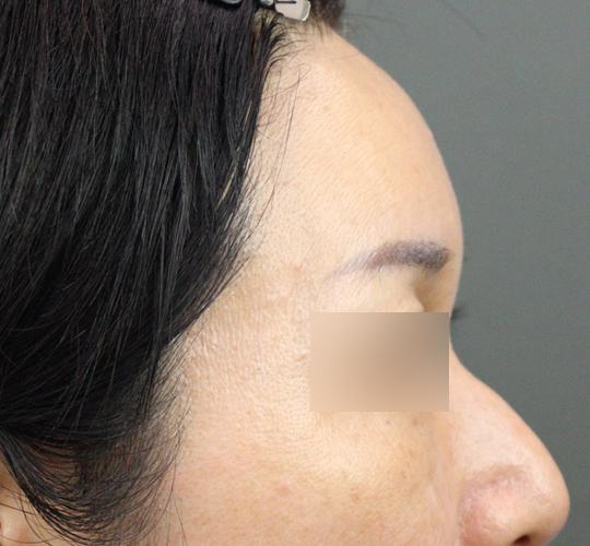 50代女性のヒアルロン酸注射 After 症例写真