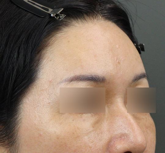 50代女性のヒアルロン酸注射（額） After 症例写真