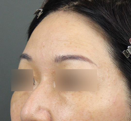 50代女性のヒアルロン酸注射（額） Before 症例写真