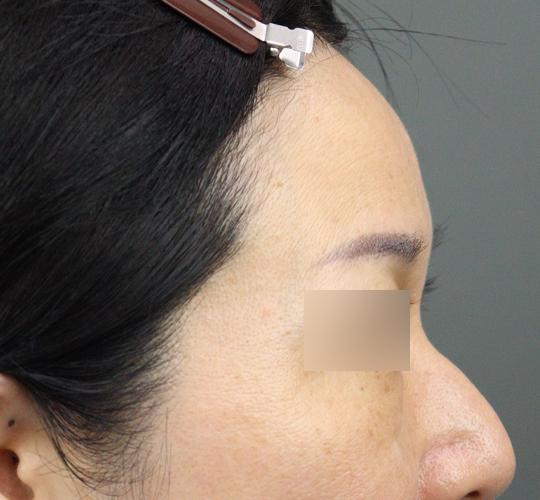 50代女性のヒアルロン酸注射 Before 症例写真