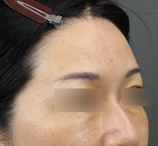 50代女性のヒアルロン酸注射（額） Before 症例写真