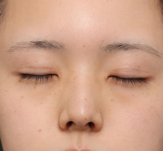 20代女性の全切開二重まぶた法 After 症例写真