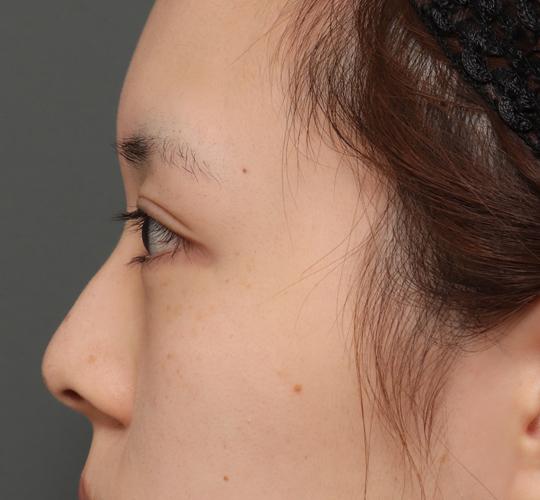 20代女性の全切開二重まぶた法 After 症例写真