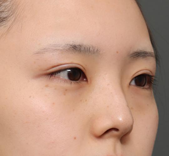 20代女性の全切開二重まぶた法 After 症例写真