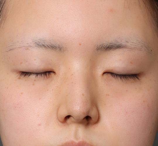 20代女性の全切開二重まぶた法 Before 症例写真