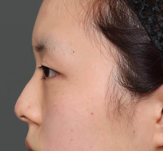 20代女性の全切開二重まぶた法 Before 症例写真