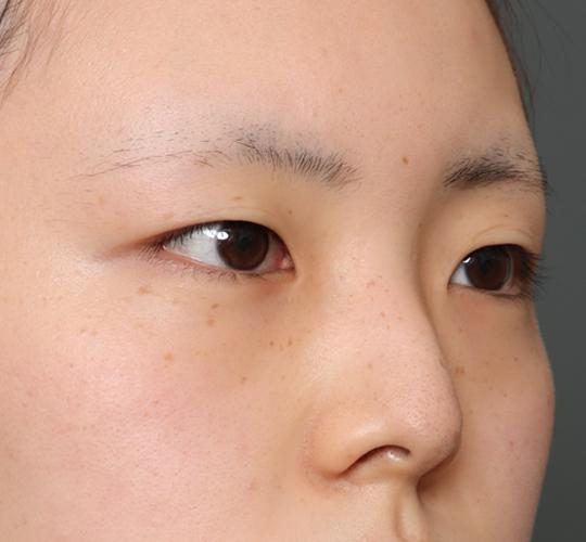 20代女性の全切開二重まぶた法 Before 症例写真