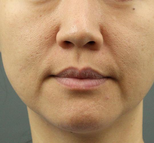 40代女性のリジュランスキンボトックス Before 症例写真