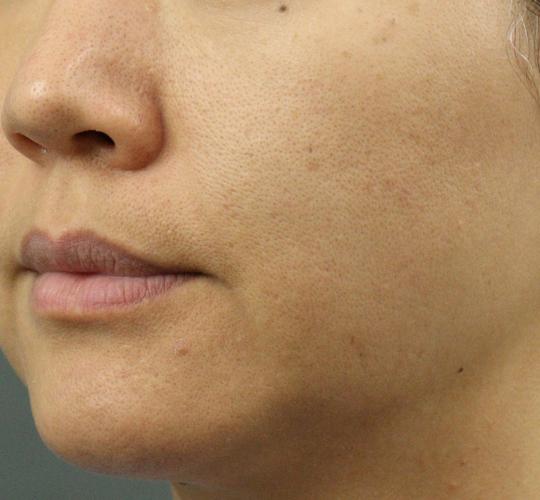 40代女性のリジュランスキンボトックス Before 症例写真