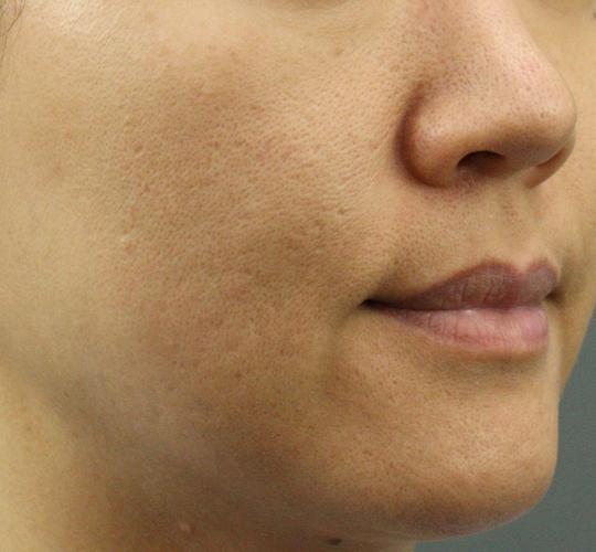 40代女性のリジュランスキンボトックス Before 症例写真