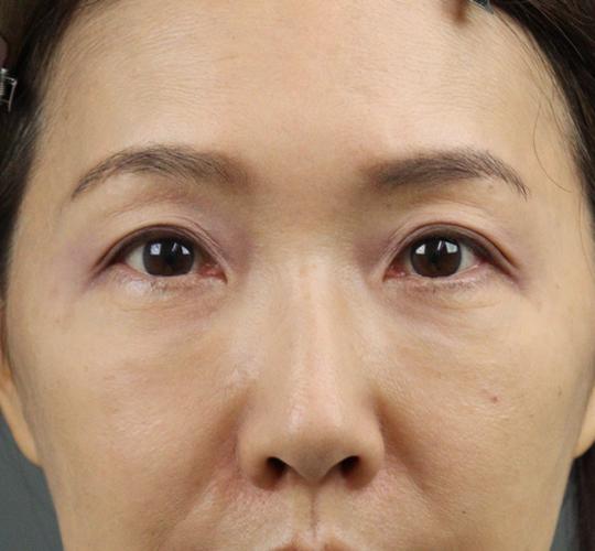 50代女性のヒアルロン酸注射 After 症例写真