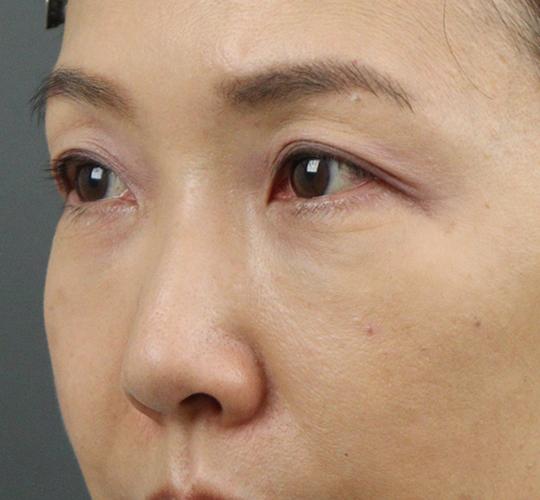 50代女性のヒアルロン酸注射（目の下） After 症例写真