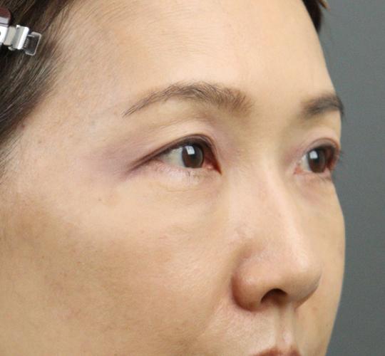 50代女性のヒアルロン酸注射（目の下） After 症例写真