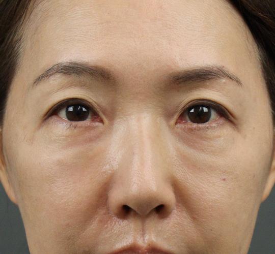 50代女性のヒアルロン酸注射 Before 症例写真