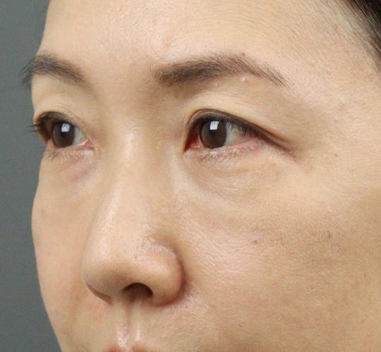 50代女性のヒアルロン酸注射（目の下） Before 症例写真
