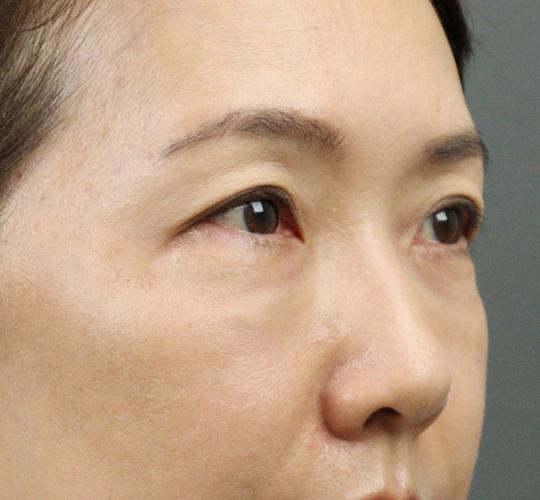 50代女性のヒアルロン酸注射（目の下） Before 症例写真
