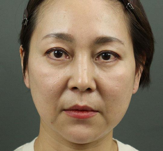 50代女性のヒアルロン酸注射 After 症例写真