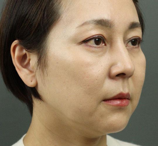 50代女性のヒアルロン酸骨格リフト Before 症例写真