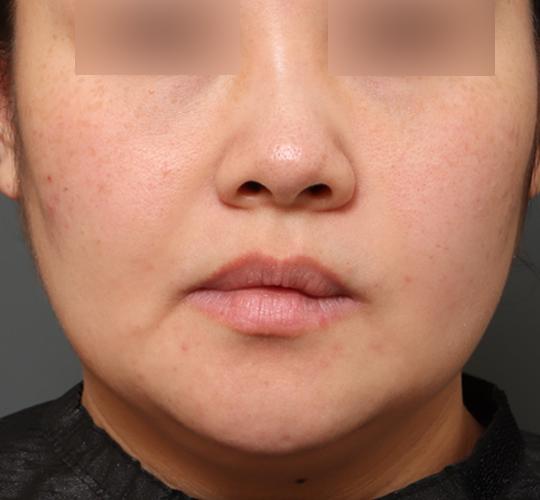 30代女性のクラリティフォトフェイシャルプラス After 症例写真