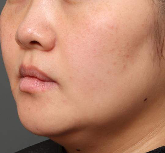 30代女性のシミ・そばかす After 症例写真