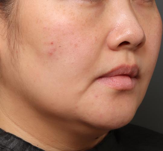 30代女性のクラリティフォトフェイシャルプラス After 症例写真