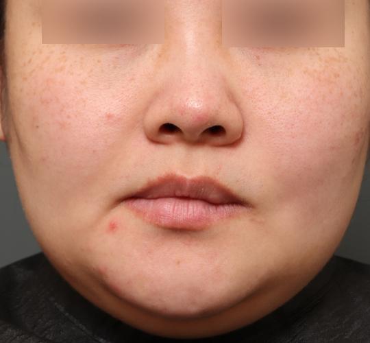 30代女性のクラリティフォトフェイシャルプラス Before 症例写真