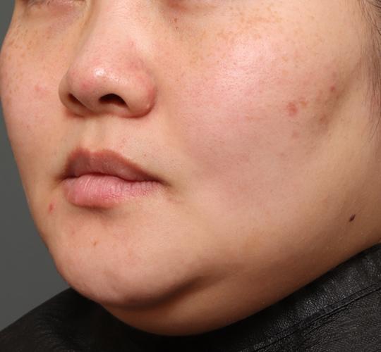 30代女性のシミ・そばかす Before 症例写真
