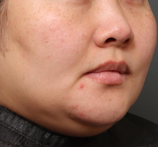 30代女性のクラリティフォトフェイシャルプラス Before 症例写真