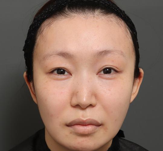 20代女性の額縮小 After 症例写真