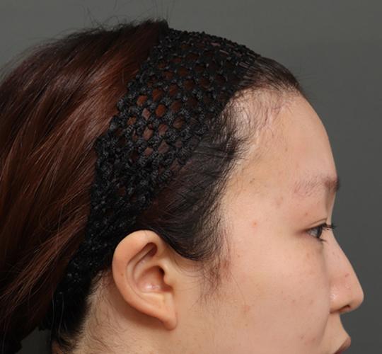20代女性の額縮小 After 症例写真