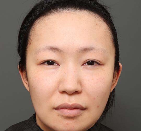 20代女性の額縮小 Before 症例写真