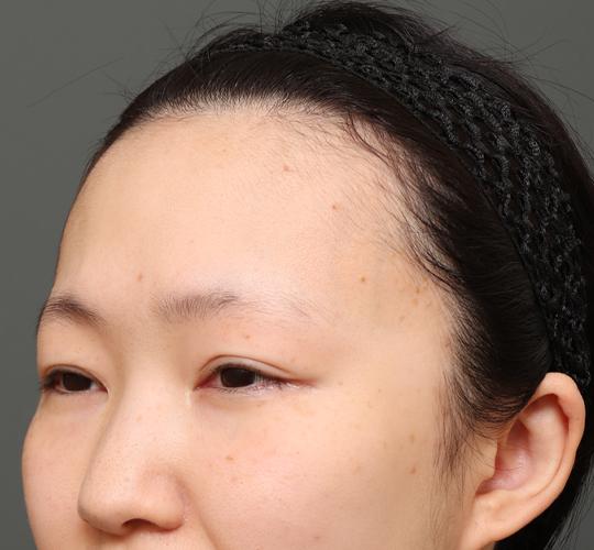 20代女性のエラ・アゴ・小顔 Before 症例写真