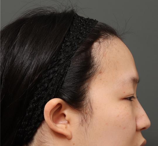 20代女性の額縮小 Before 症例写真
