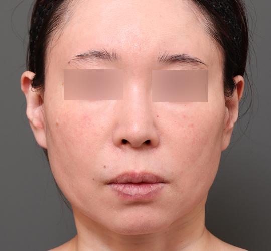 50代女性の二重アゴ筋肉縛り（ペリカン手術） After 症例写真