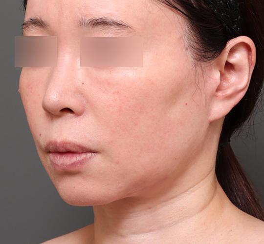 50代女性のエラ・アゴ・小顔 After 症例写真