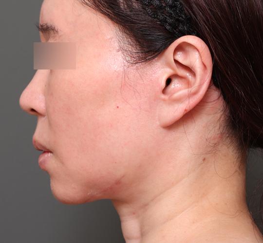 50代女性の二重アゴ筋肉縛り（ペリカン手術） After 症例写真