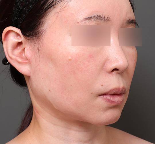 50代女性の二重アゴ筋肉縛り（ペリカン手術） After 症例写真