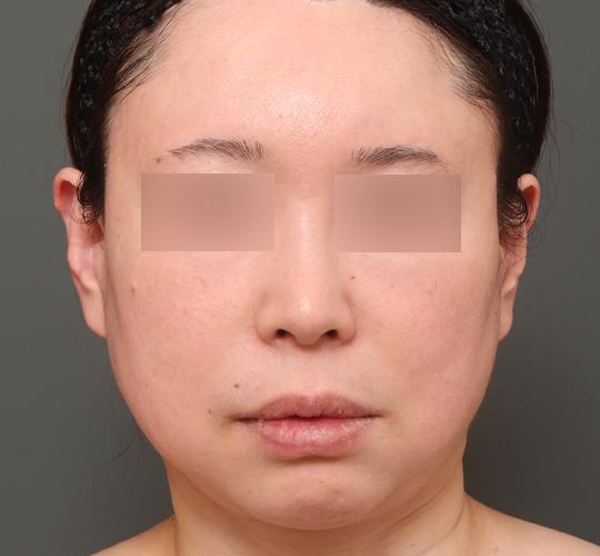 50代女性の二重アゴ筋肉縛り（ペリカン手術） Before 症例写真