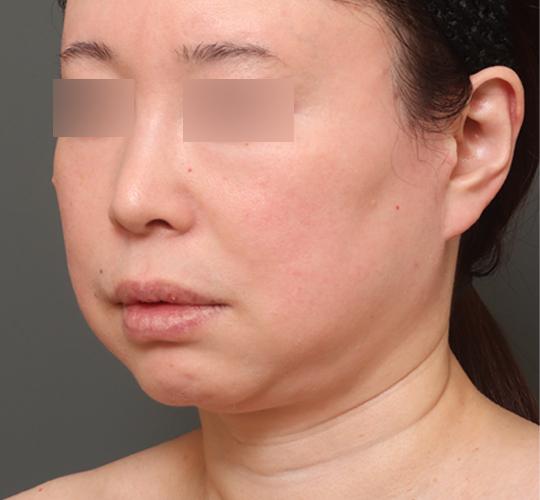 50代女性のエラ・アゴ・小顔 Before 症例写真
