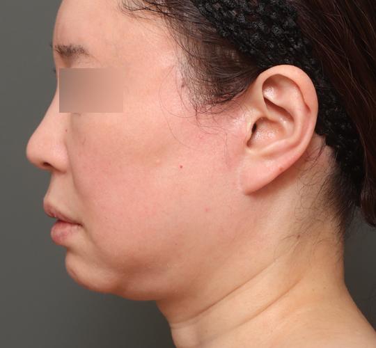 50代女性の二重アゴ筋肉縛り（ペリカン手術） Before 症例写真