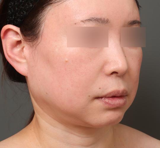 50代女性の二重アゴ筋肉縛り（ペリカン手術） Before 症例写真