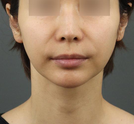 40代女性のボトックス（輪郭＆広頚筋ボトックス） After 症例写真