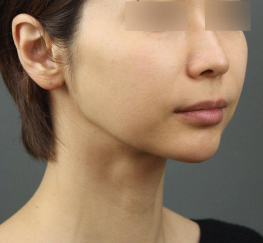 40代女性のエラ・アゴ・小顔 After 症例写真